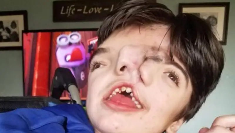 Мальчику с двумя лицами, которому пророчили смерть, исполнилось 13 лет