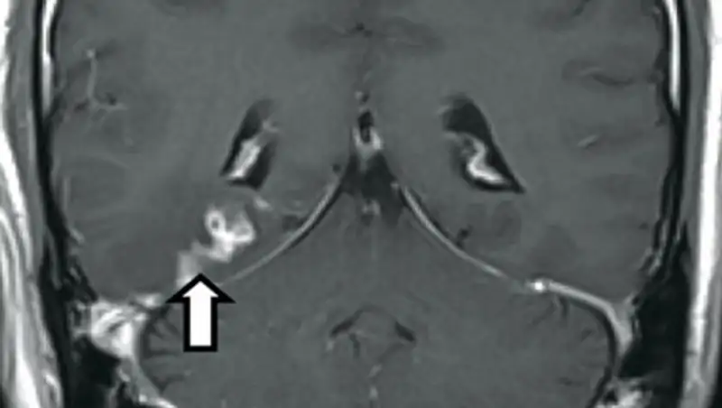 Ленточный червь четыре года жил в мозгу у британца