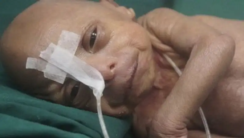 В Бангладеш родился "Бенджамин Баттон"