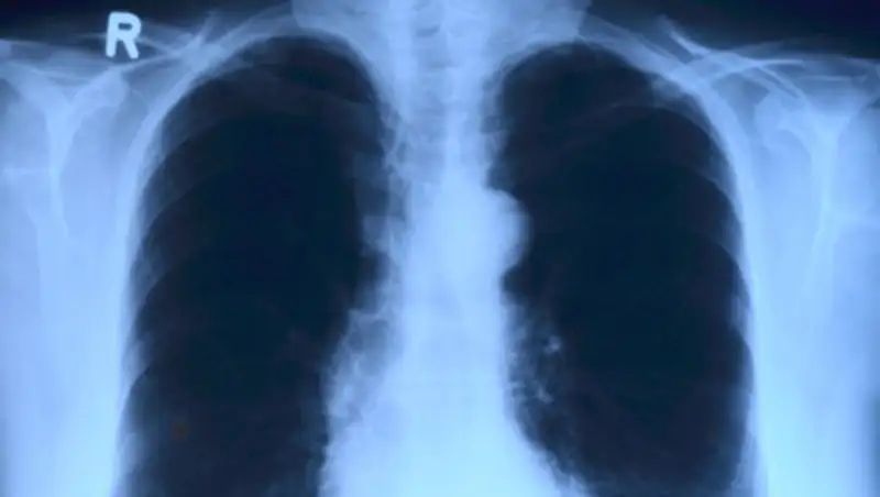 В Алматы вылечили пациента с 88% поражением легких