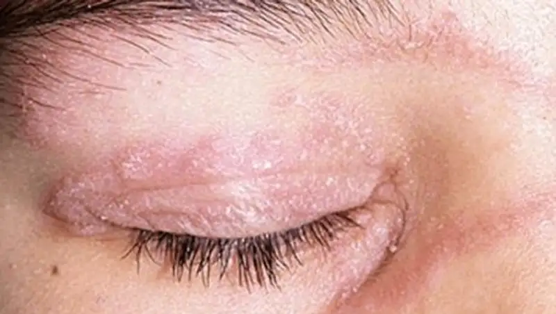 Как микроскопический клещ может навредить зрению