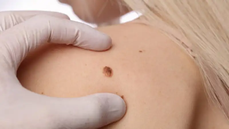 Врач рассказала, какие родинки нужно считать опасными