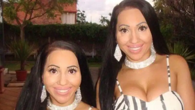 Близняшки пожалели о том, что потратили $250 тысяч на пластические операции