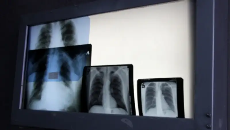 В Усть-Каменогорске ученица с открытой формой туберкулёза ходила на занятия