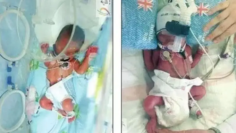 Женщина родила близнецов через 6 дней после рождения первенца