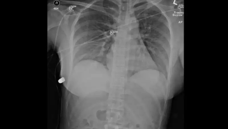 Женщина поймала пулю грудью и выжила благодаря имплантам