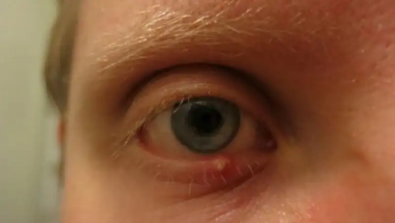 Ячмень на глазу: почему он "вскакивает" и как его лечить