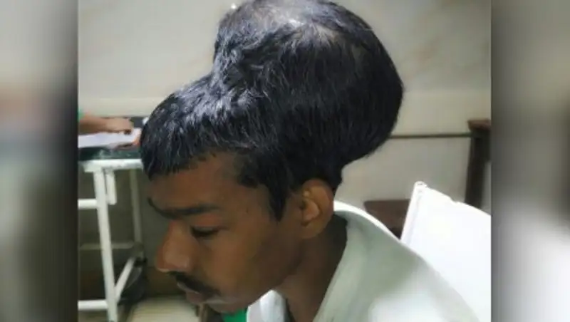 В Индии врачи удалили пациенту самую большую опухоль в мире