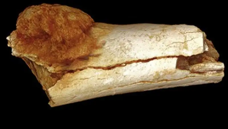 Обнаружена самая древняя раковая опухоль у людей