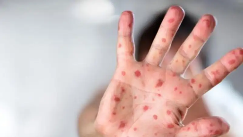 В Европе растет число заболевших корью