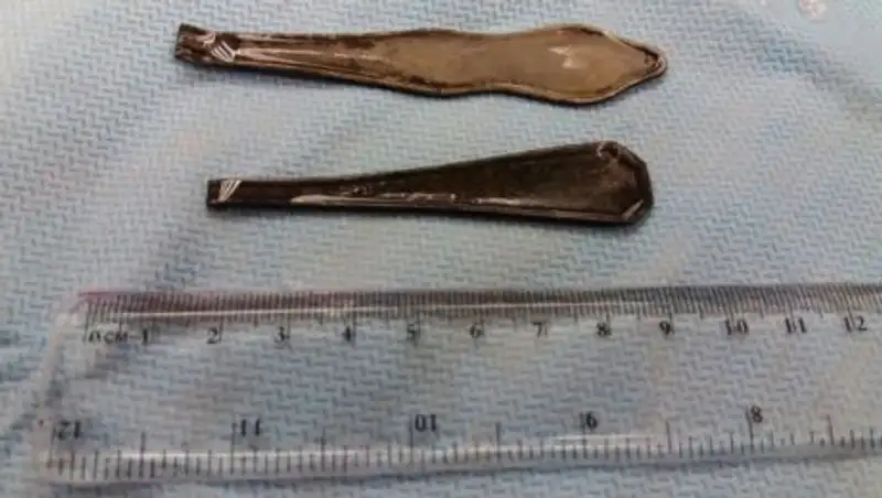 В Актау хирурги извлекли из желудка пациента две ручки от ложек