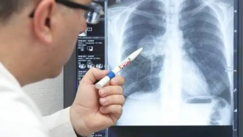 Четыре смерти, 117 заболевших. Данные о пневмонии с признаками коронавируса