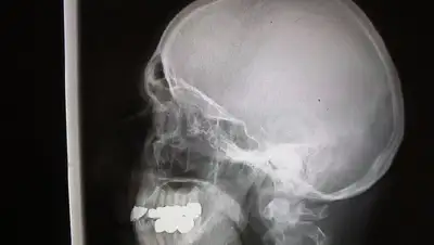 Голова, Черепно-мозговая травма, восстановление , фото - Новости Zakon.kz от 16.06.2022 16:09