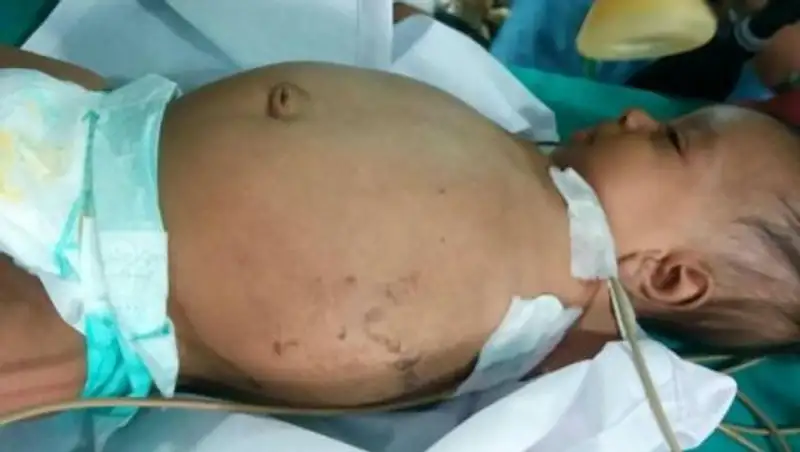 Это не опухоль: внутри ребенка рос близнец-паразит