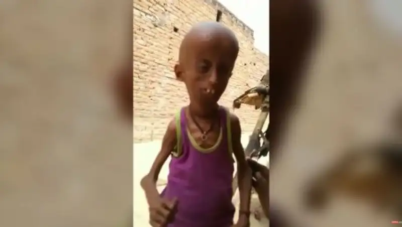 В Индии найден Бенджамин Баттон: 21-летний парень выглядит как 160-летний