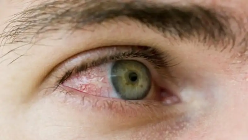 О чем говорят красные глаза