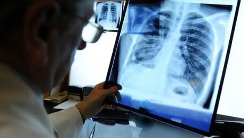 Открытый туберкулез выявили у двух студентов Алматы