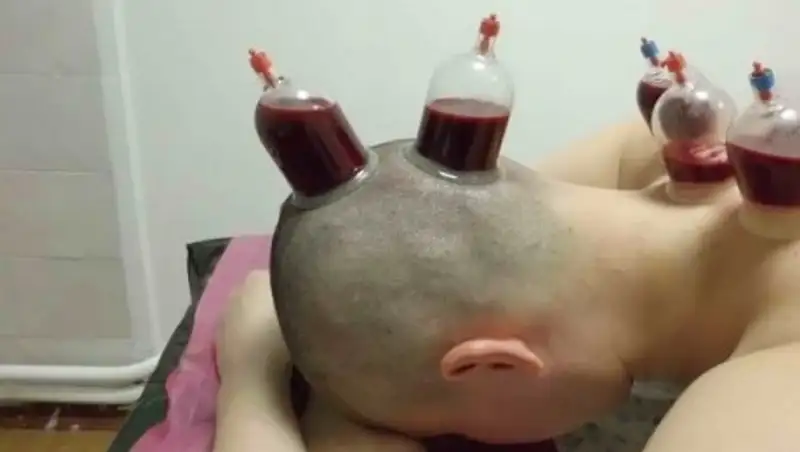 Алматылық тұрғын емшінің емінен кейін ауруханаға түсіп қалды