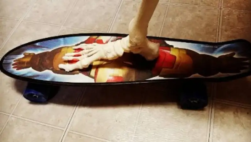 Девушка посвятила Instagram своей отрезанной ноге