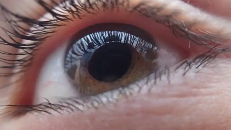 Катаракта - самые эффективные методики лечения