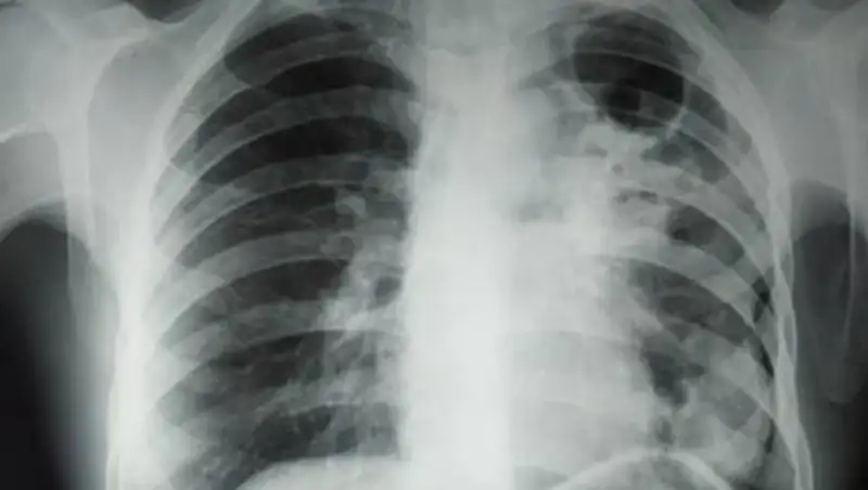 Как отличить COVID-19 от туберкулеза