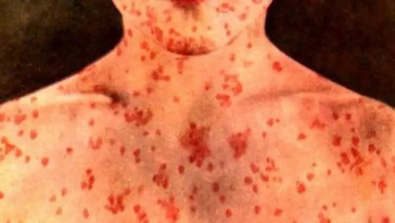 Европейские медики бьют тревогу: От кори скончалось уже 37 человек