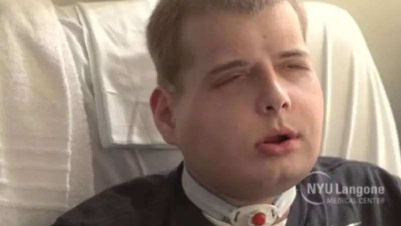 Хирурги в США провели полную пересадку лица