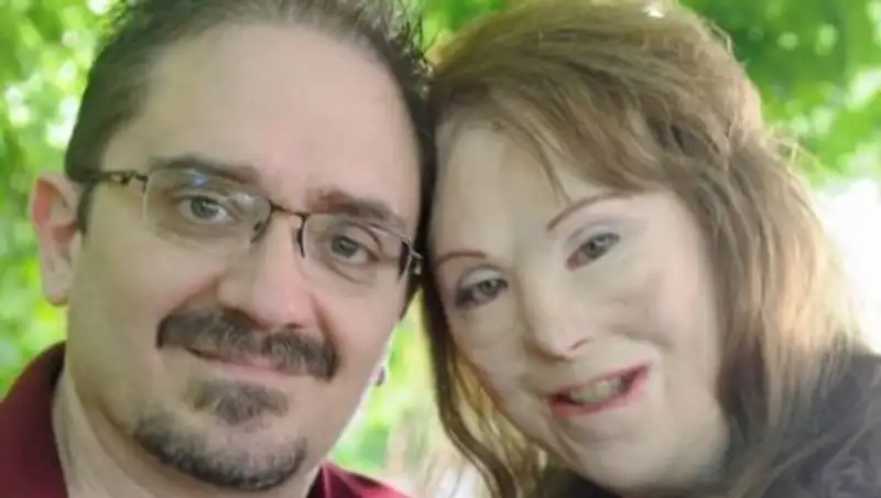 После пожара женщина перенесла 100 операций и 40 лет заточения