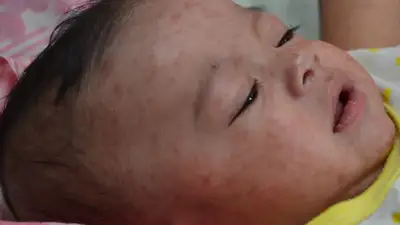 Шесть детей в реанимации: корь стремительно распространяется в Актюбинской области 