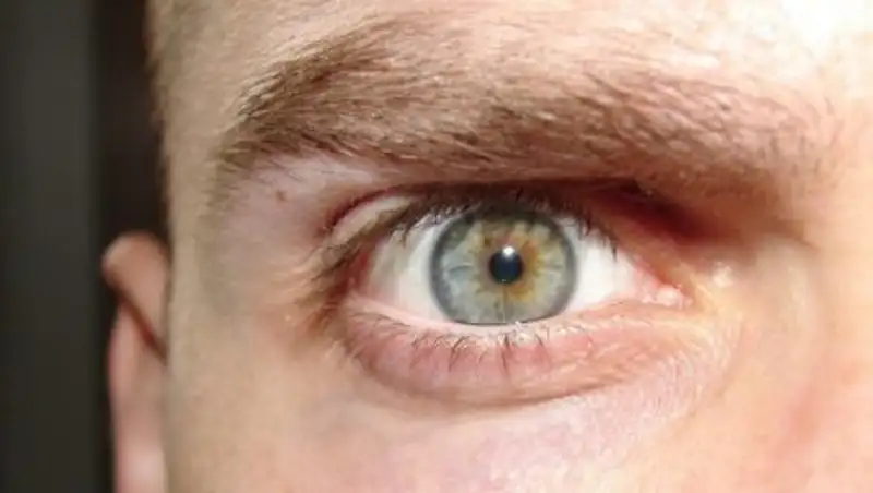 Как лечить воспаление сетчатки глаза