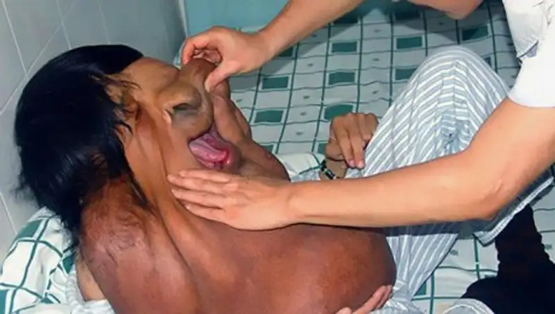 Китайский "Человек-слон" с опухолью на лице отказался участвовать в развлекательном шоу