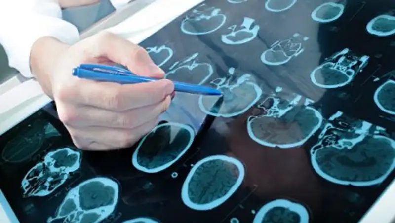 Ученые обнаружили вирус, который борется с раком мозга