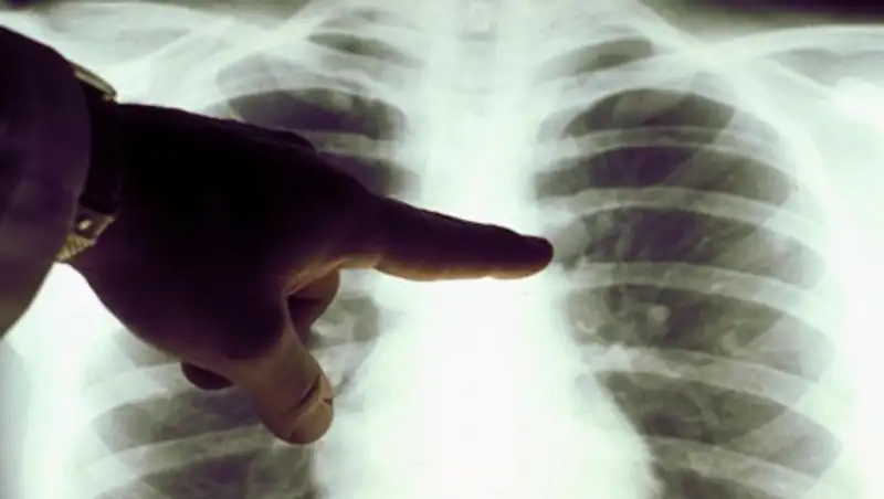 За год в 2 раза увеличилось число смертей от пневмонии - Цой