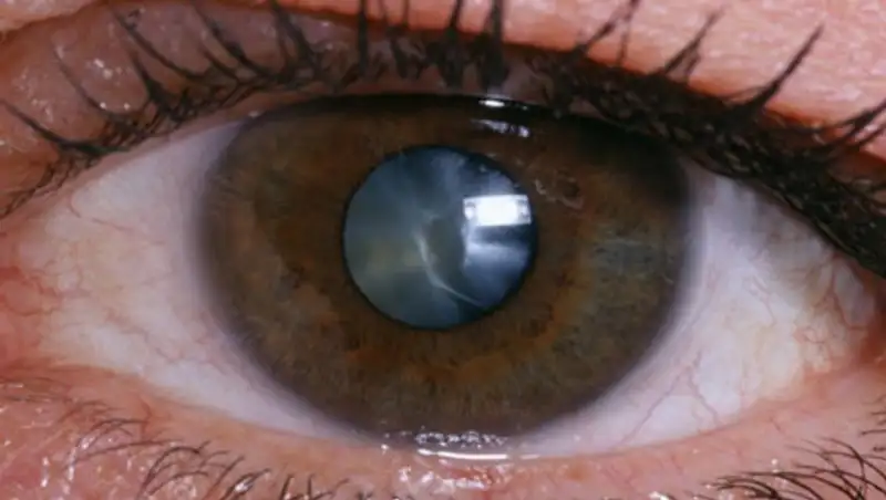 Причины и признаки возникновения катаракты