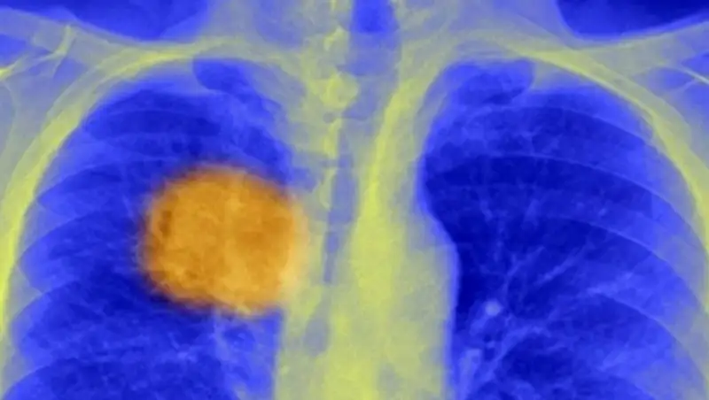 Ученые обещают, что скоро рак будут лечить одним уколом