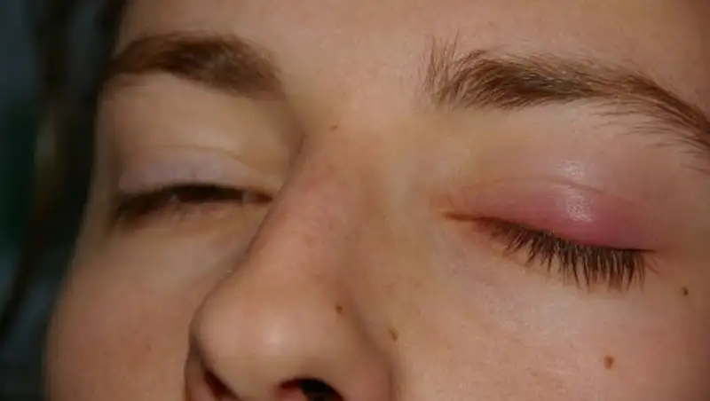 Как лечить халязион