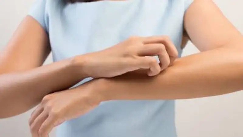 Врач предупредила об опасных последствиях расчесывания комариных укусов