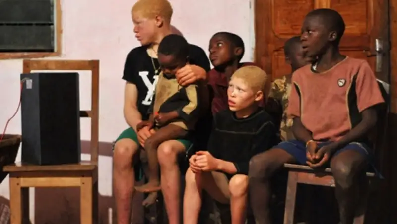 В Танзании запретили колдовство ради спасения альбиносов