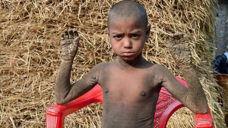 Редкая болезнь превращает 8-летнего мальчика из Бангладеш в камень