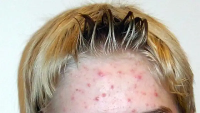 Названа причина появления прыщей