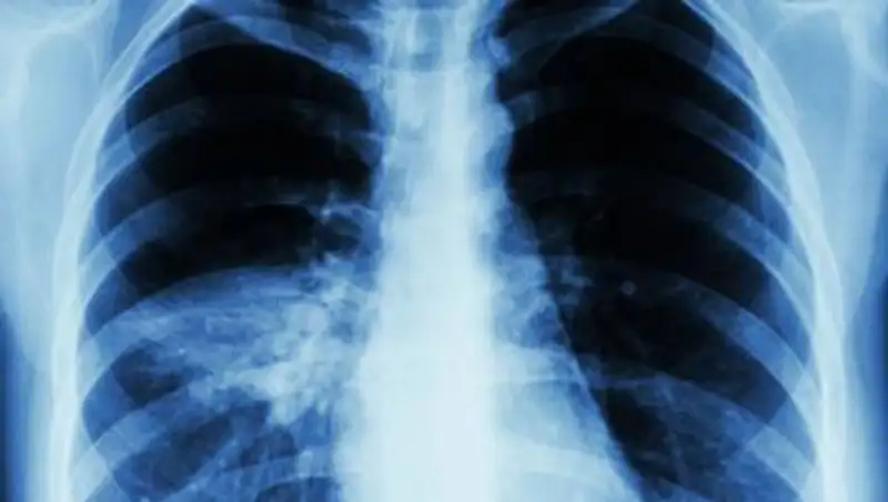 За сутки ни один человек не скончался от пневмонии