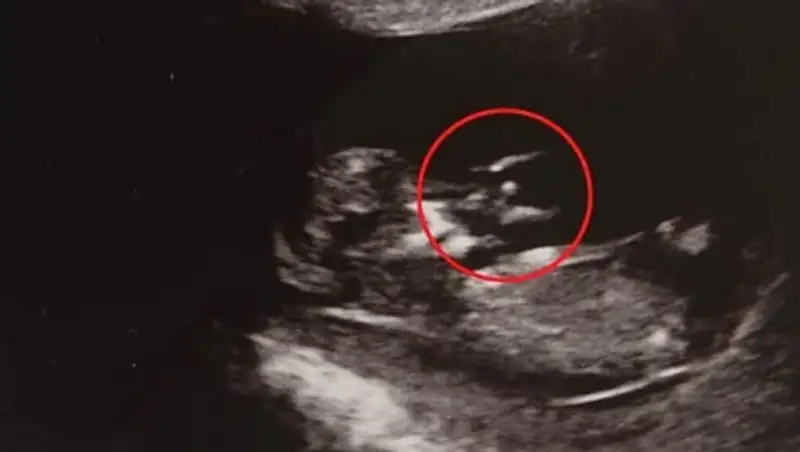 На внутриутробном снимке эмбриона разглядели ангела