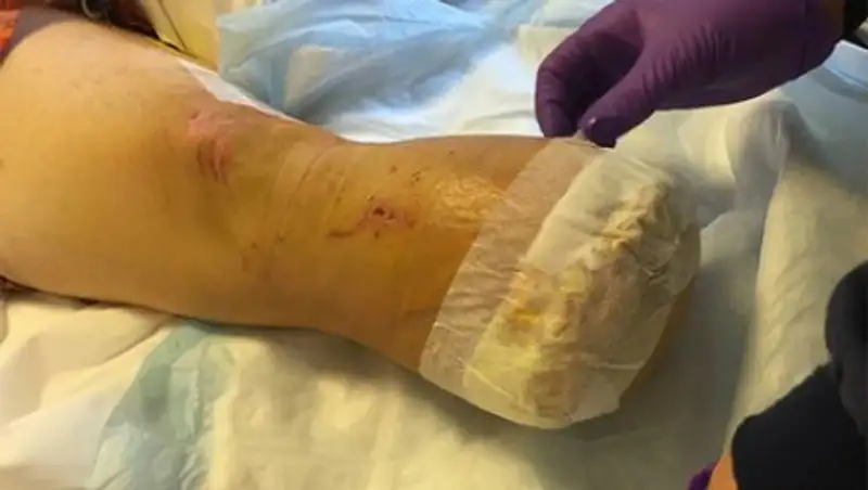 Американец пожарил свою ногу и накормил ей друзей