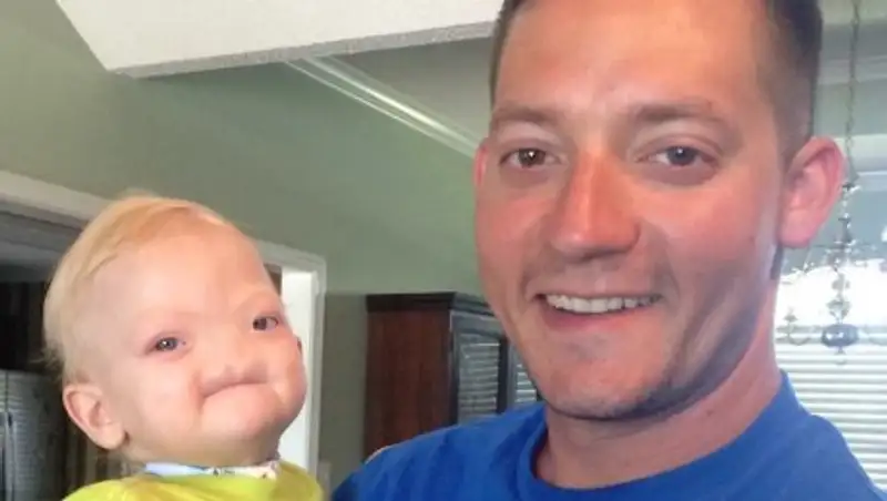 Родившийся без носа мальчик умер в возрасте двух лет в США