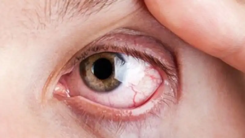 Как вылечить конъюнктивит