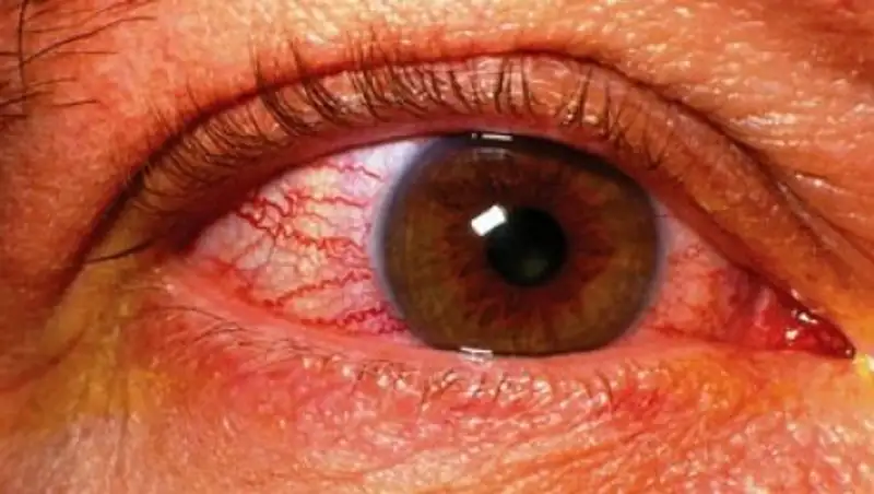 Насколько опасен для зрения разрыв сетчатки