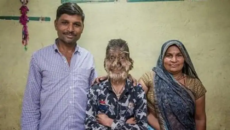 Редкое заболевание сделало мальчика похожим на оборотня