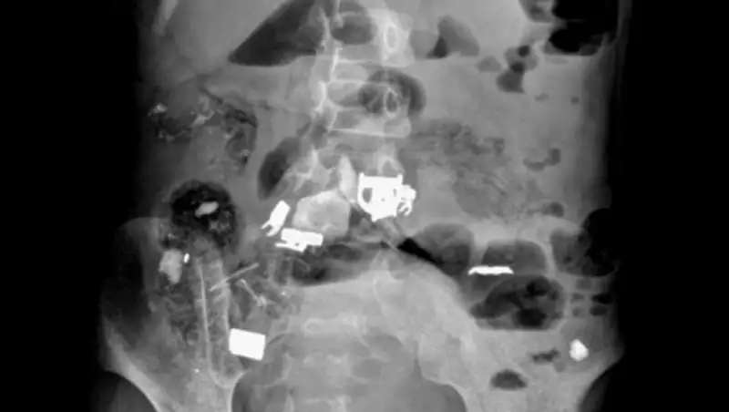 У девочки из живота вытащили волосы, ручку, железо и скотч