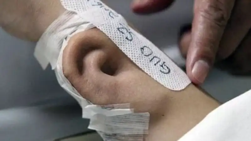 В Китае врачи пришили человеку ухо, которое вырастили на его руке