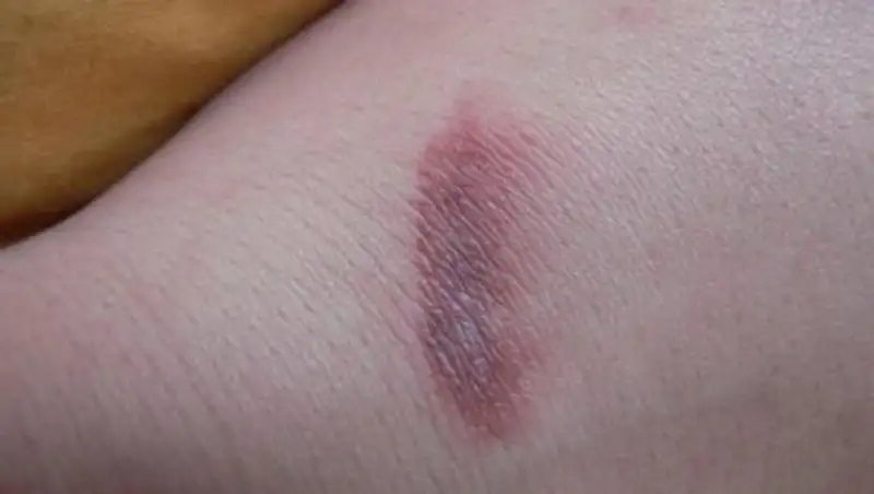 iPhone прожёг руку американке во сне